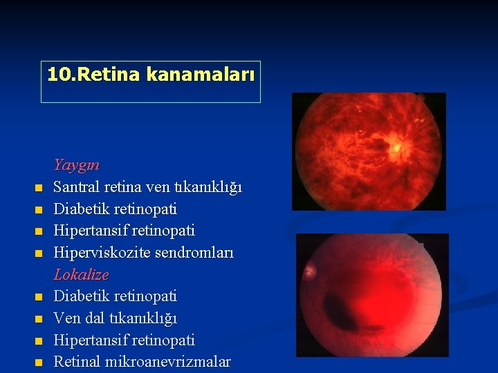 10. Retina kanamaları n n n n Yaygın Santral retina ven tıkanıklığı Diabetik retinopati