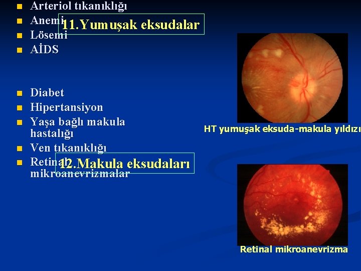 n n n n n Arteriol tıkanıklığı Anemi 11. Yumuşak eksudalar Lösemi AİDS Diabet