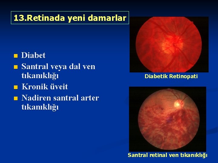13. Retinada yeni damarlar n n Diabet Santral veya dal ven tıkanıklığı Kronik üveit