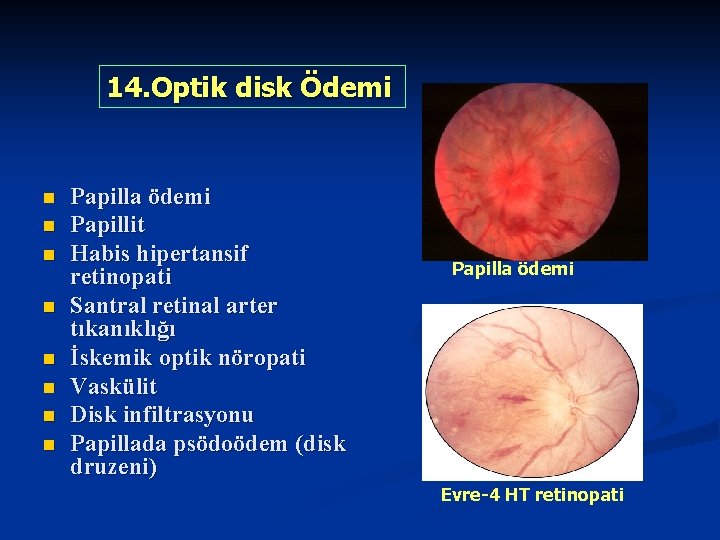 14. Optik disk Ödemi n n n n Papilla ödemi Papillit Habis hipertansif retinopati