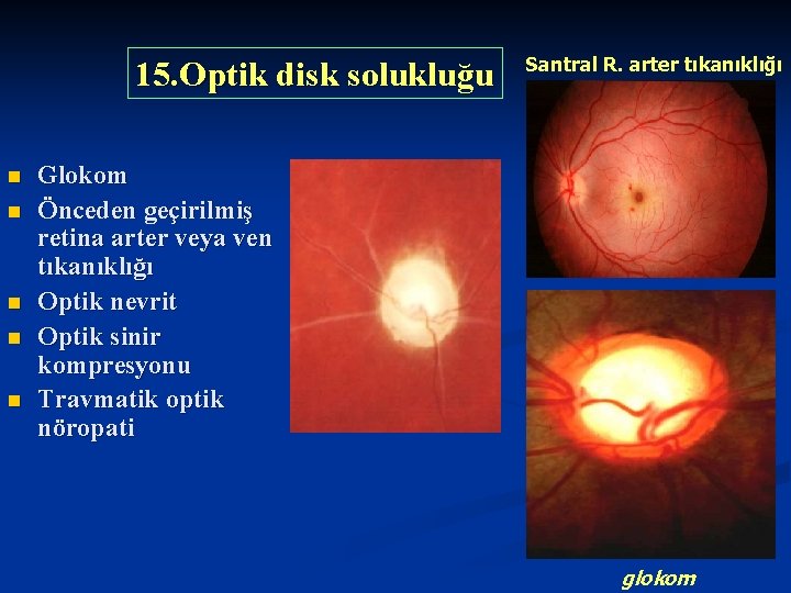 15. Optik disk solukluğu n n n Santral R. arter tıkanıklığı Glokom Önceden geçirilmiş