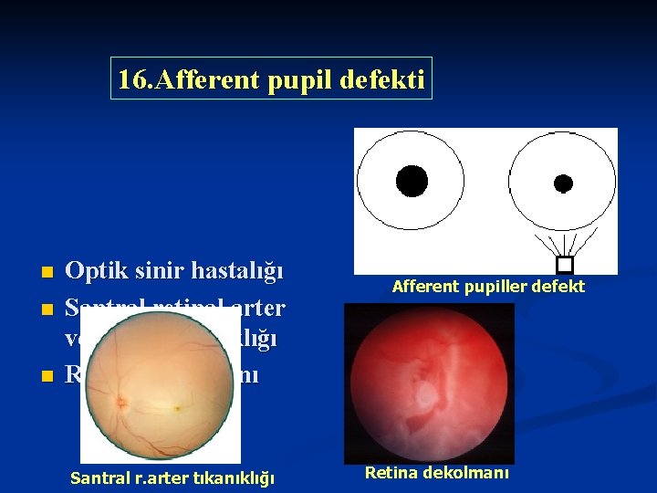 16. Afferent pupil defekti n n n Optik sinir hastalığı Santral retinal arter veya