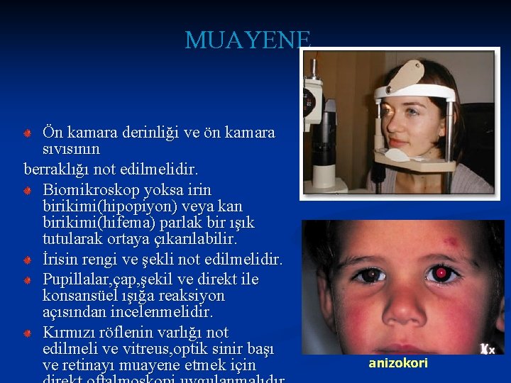 MUAYENE Ön kamara derinliği ve ön kamara sıvısının berraklığı not edilmelidir. Biomikroskop yoksa irin