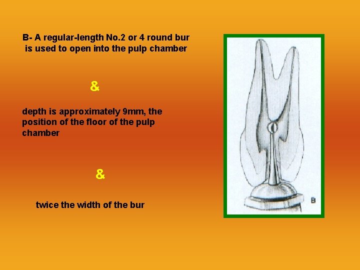 B- A regular-length No. 2 or 4 round bur is used to open into