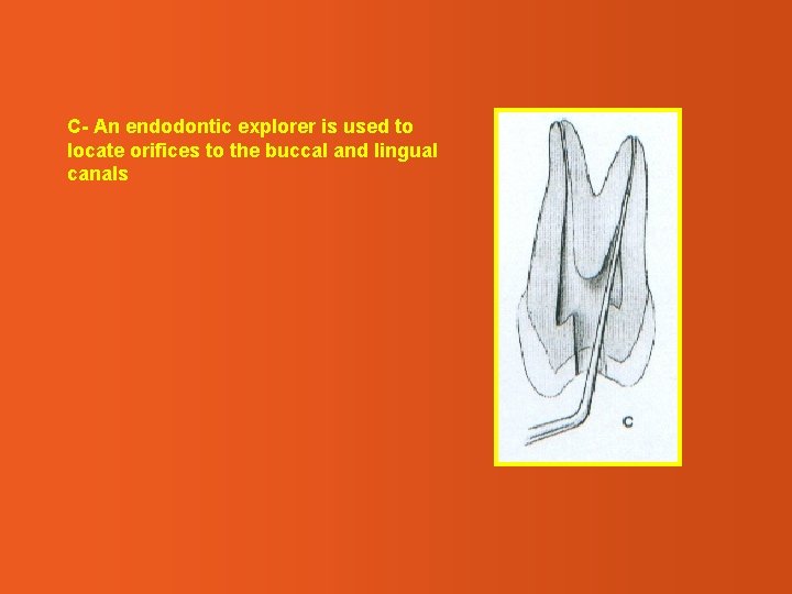 C- An endodontic explorer is used to locate orifices to the buccal and lingual