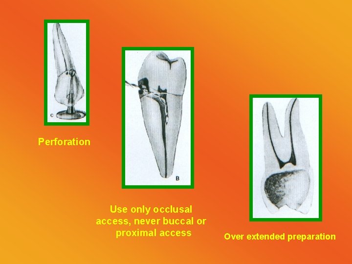 Perforation Use only occlusal access, never buccal or proximal access Over extended preparation 