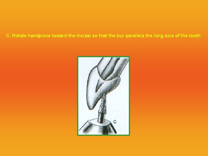 C- Rotate handpiece toward the incisal so that the bur parallels the long axis
