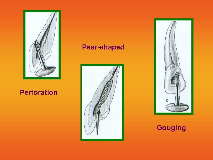 Pear-shaped Perforation Gouging 