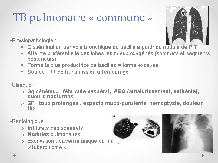 TB pulmonaire « commune » • Physiopathologie : § Dissémination par voie bronchique du