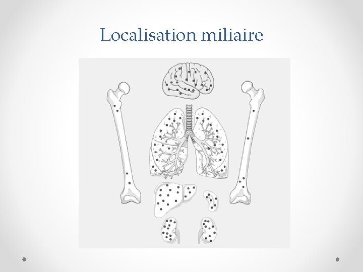 Localisation miliaire 