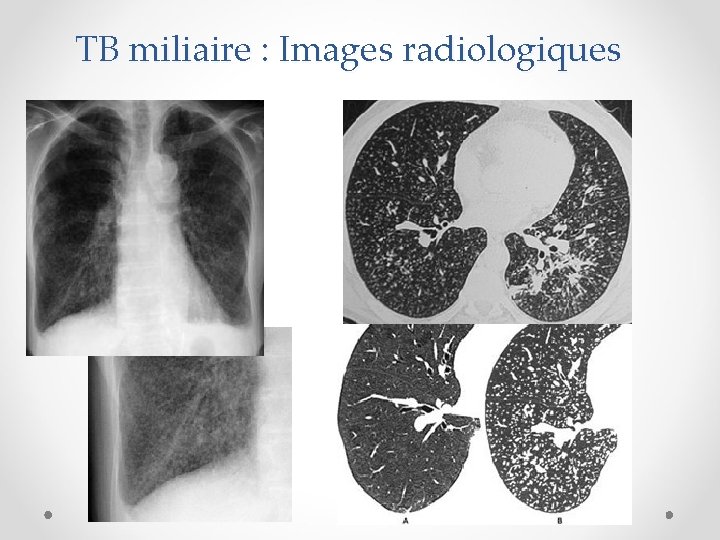 TB miliaire : Images radiologiques 