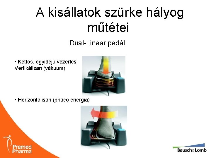 A kisállatok szürke hályog műtétei Dual-Linear pedál • Kettős, egyidejű vezérlés Vertikálisan (vákuum) •