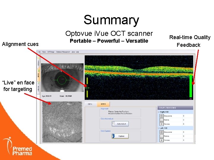 Summary Optovue i. Vue OCT scanner Alignment cues “Live” en face for targeting Portable