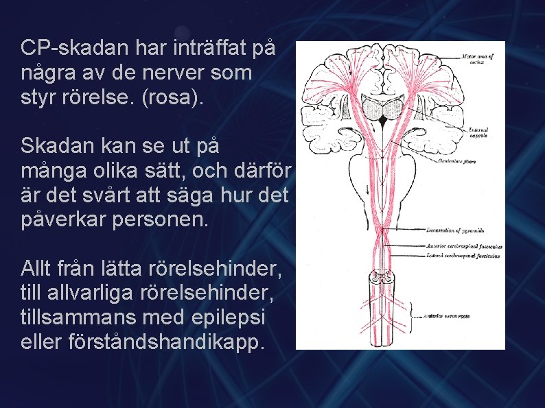 CP-skadan har inträffat på några av de nerver som styr rörelse. (rosa). Skadan kan