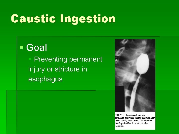 Caustic Ingestion § Goal § Preventing permanent injury or stricture in esophagus 