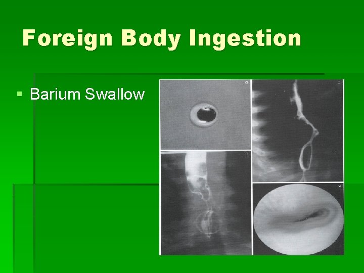 Foreign Body Ingestion § Barium Swallow 