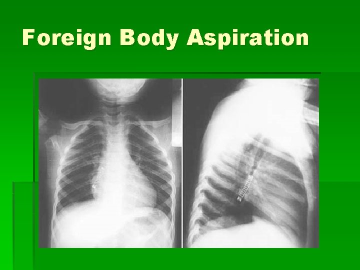 Foreign Body Aspiration 