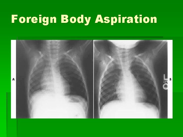 Foreign Body Aspiration 