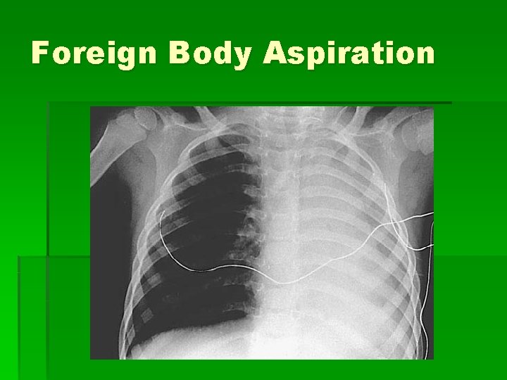 Foreign Body Aspiration 