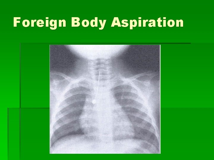 Foreign Body Aspiration 