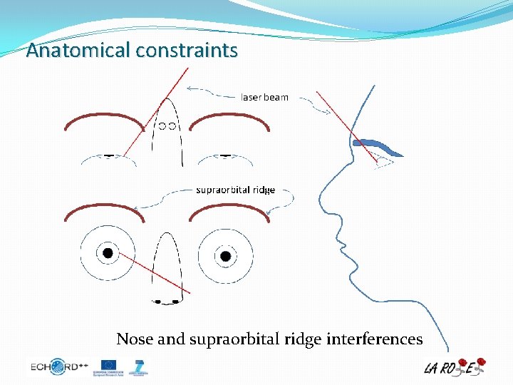 Anatomical constraints Nose and supraorbital ridge interferences 