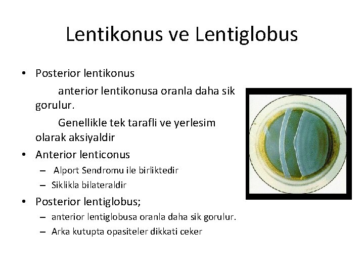 Lentikonus ve Lentiglobus • Posterior lentikonus anterior lentikonusa oranla daha sik gorulur. Genellikle tek