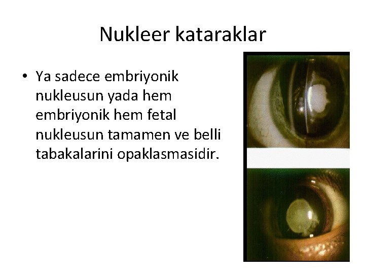 Nukleer kataraklar • Ya sadece embriyonik nukleusun yada hem embriyonik hem fetal nukleusun tamamen