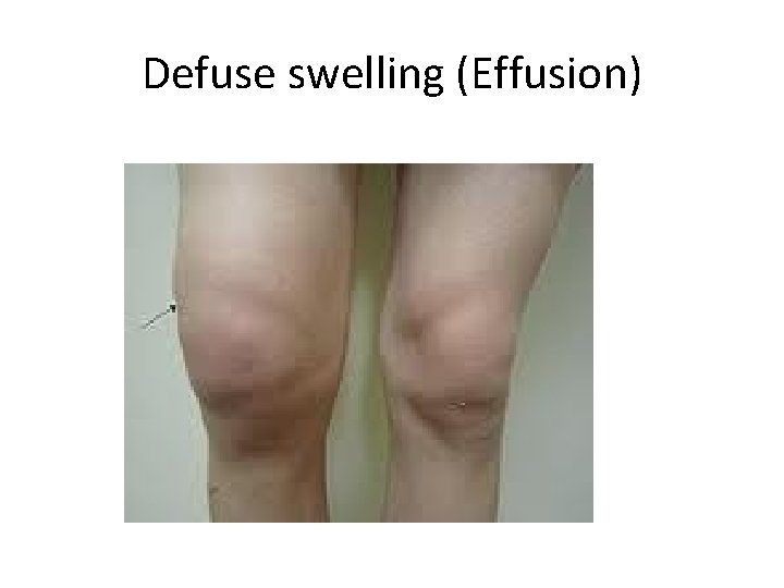 Defuse swelling (Effusion) 