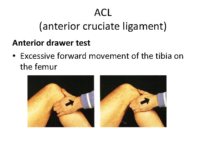 ACL (anterior cruciate ligament) Anterior drawer test • Excessive forward movement of the tibia