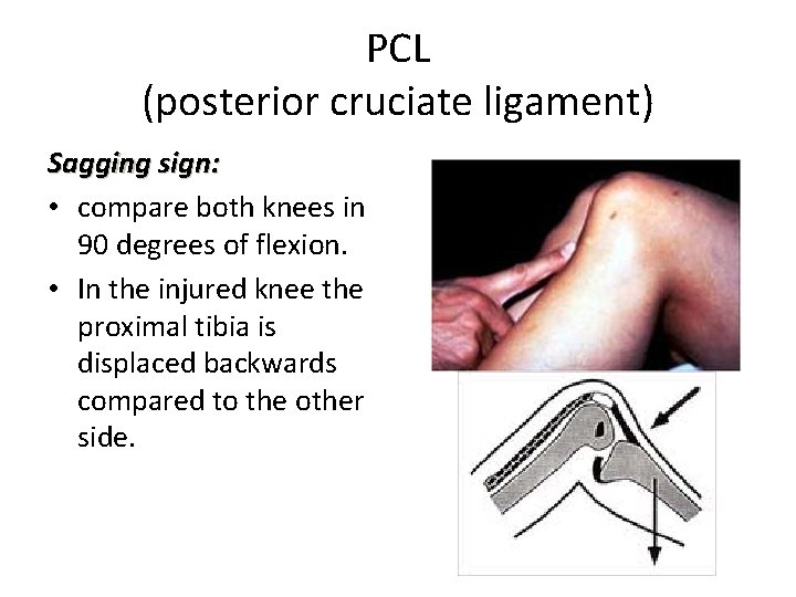 PCL (posterior cruciate ligament) Sagging sign: • compare both knees in 90 degrees of