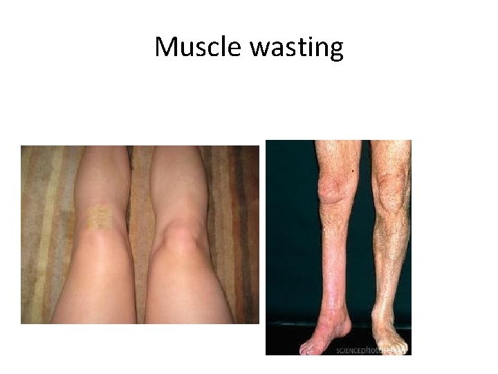 Muscle wasting 