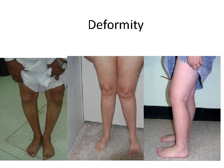 Deformity 