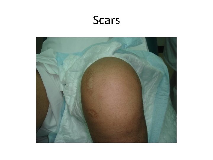 Scars 