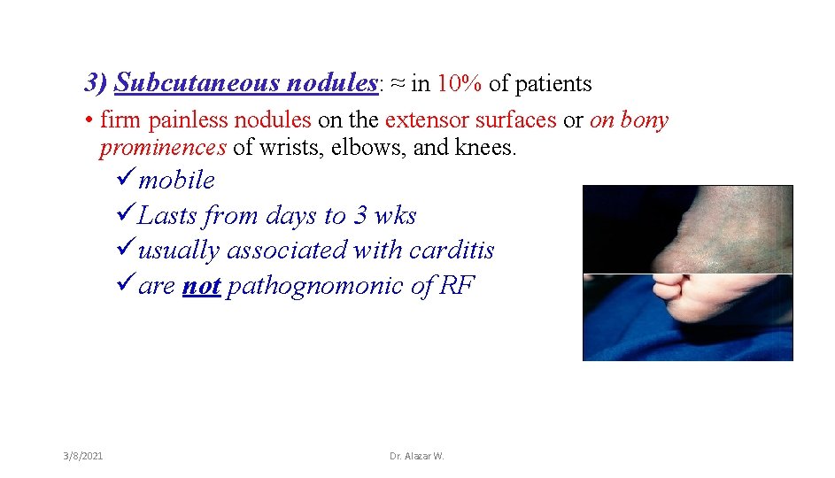 3) Subcutaneous nodules: ≈ in 10% of patients • firm painless nodules on the