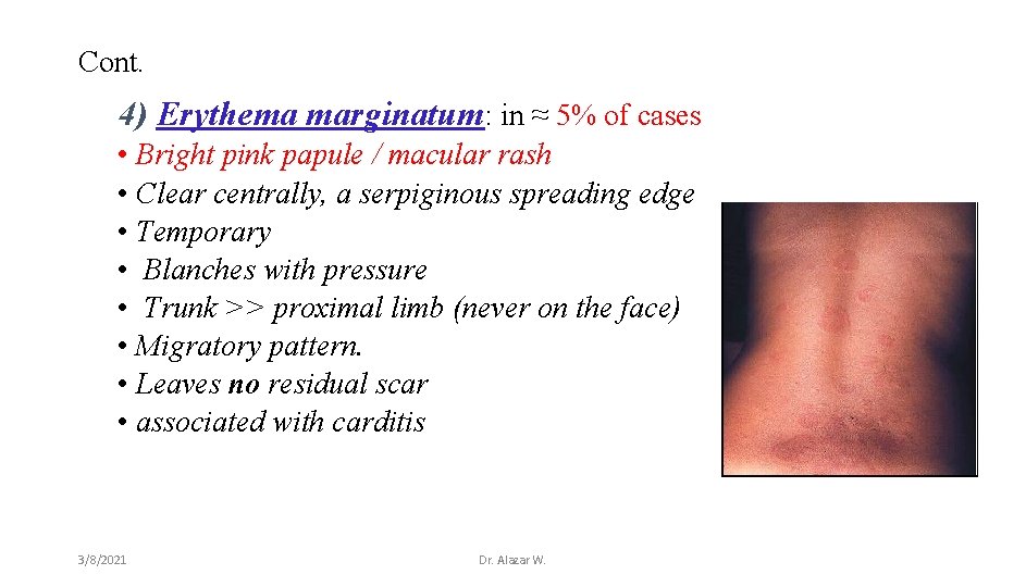 Cont. 4) Erythema marginatum: in ≈ 5% of cases • Bright pink papule /