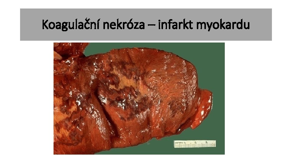 Koagulační nekróza – infarkt myokardu 