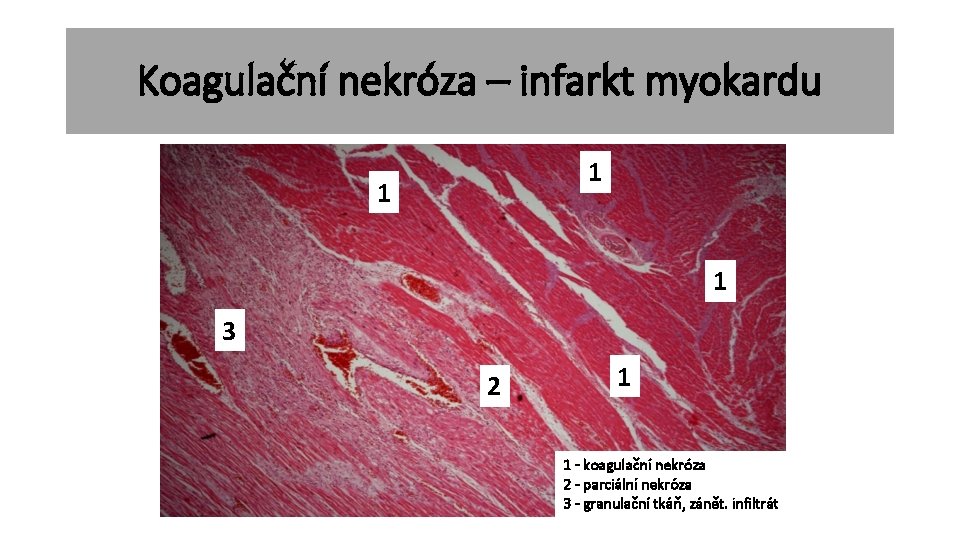 Koagulační nekróza – infarkt myokardu 1 1 1 3 2 1 1 - koagulační