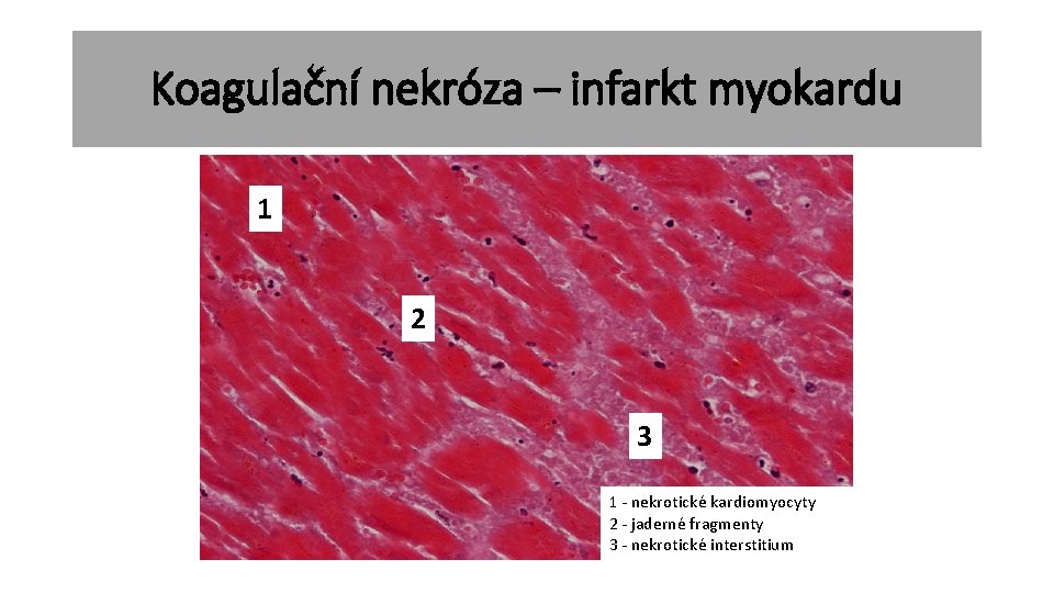 Koagulační nekróza – infarkt myokardu 1 2 3 1 - nekrotické kardiomyocyty 2 -