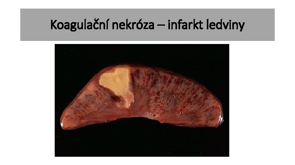 Koagulační nekróza – infarkt ledviny 
