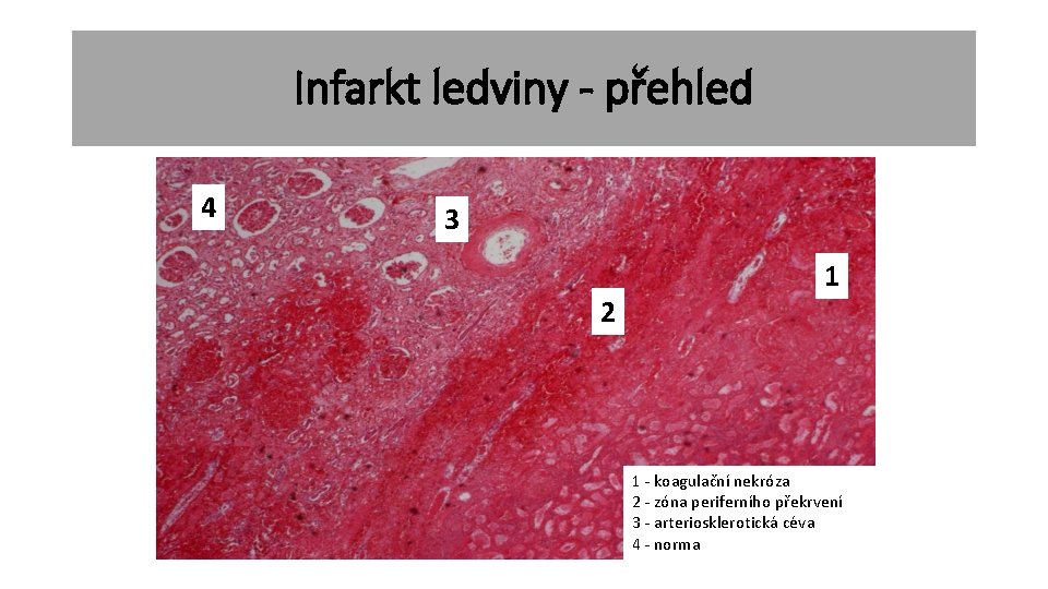 Infarkt ledviny - přehled 4 3 2 1 1 - koagulační nekróza 2 -