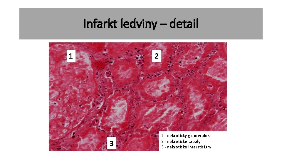 Infarkt ledviny – detail 1 2 3 1 - nekrotický glomerulus 2 - nekrotické