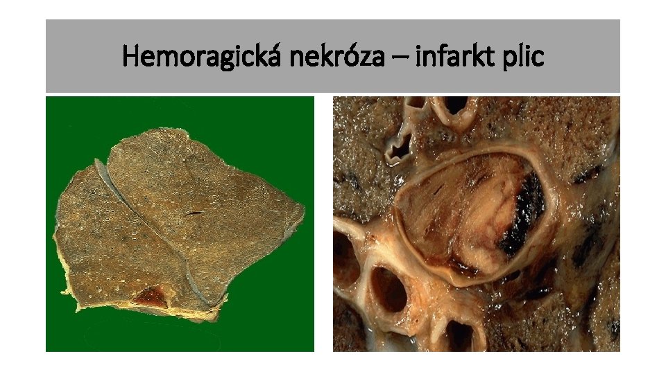 Hemoragická nekróza – infarkt plic 