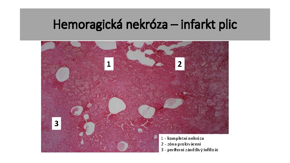 Hemoragická nekróza – infarkt plic 1 2 3 1 - kompletní nekróza 2 -