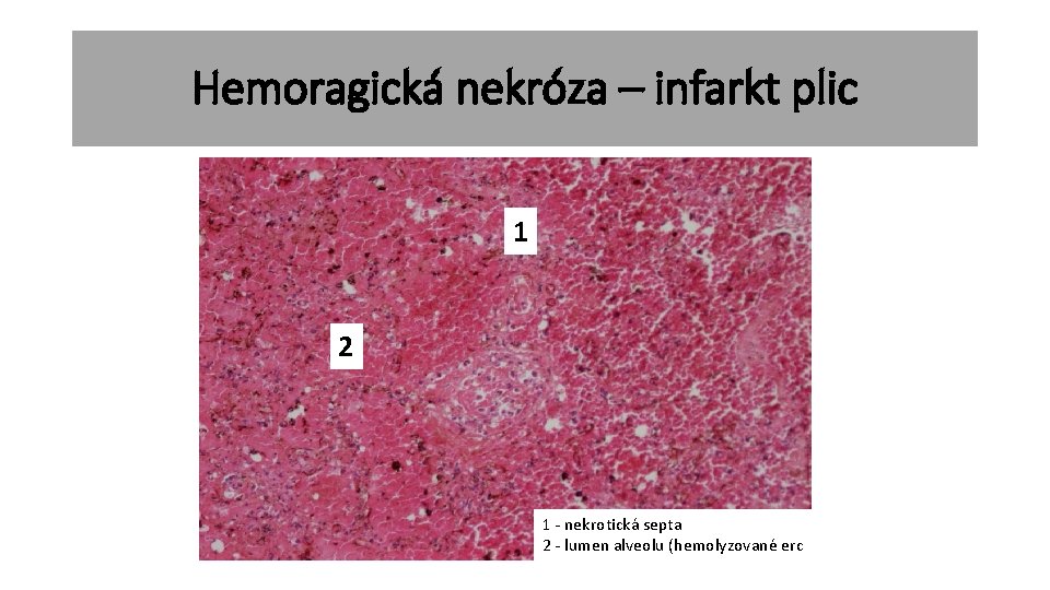 Hemoragická nekróza – infarkt plic 1 2 1 - nekrotická septa 2 - lumen