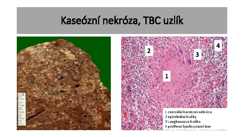 Kaseózní nekróza, TBC uzlík 4 2 3 1 1 centrální kazeózní nekróza 2 epiteloidní