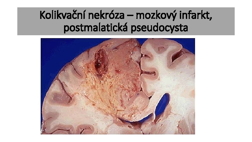 Kolikvační nekróza – mozkový infarkt, postmalatická pseudocysta 