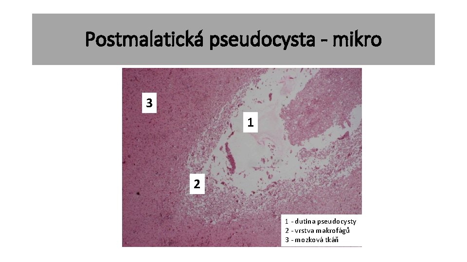 Postmalatická pseudocysta - mikro 3 1 2 1 - dutina pseudocysty 2 - vrstva