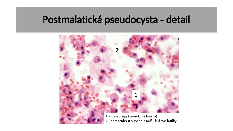 Postmalatická pseudocysta - detail 2 1 1 - makrofágy (zrnéčkové buňky) 2 - hemosiderin