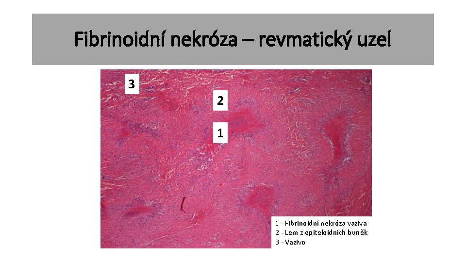 Fibrinoidní nekróza – revmatický uzel 3 2 1 1 2 1 - Fibrinoidní nekróza