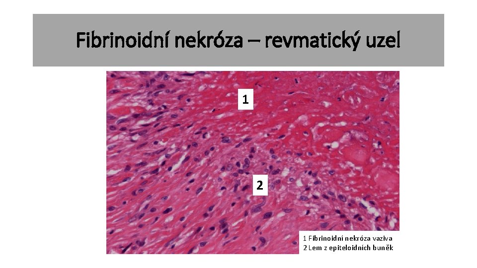 Fibrinoidní nekróza – revmatický uzel 1 2 1 Fibrinoidní nekróza vaziva 2 Lem z